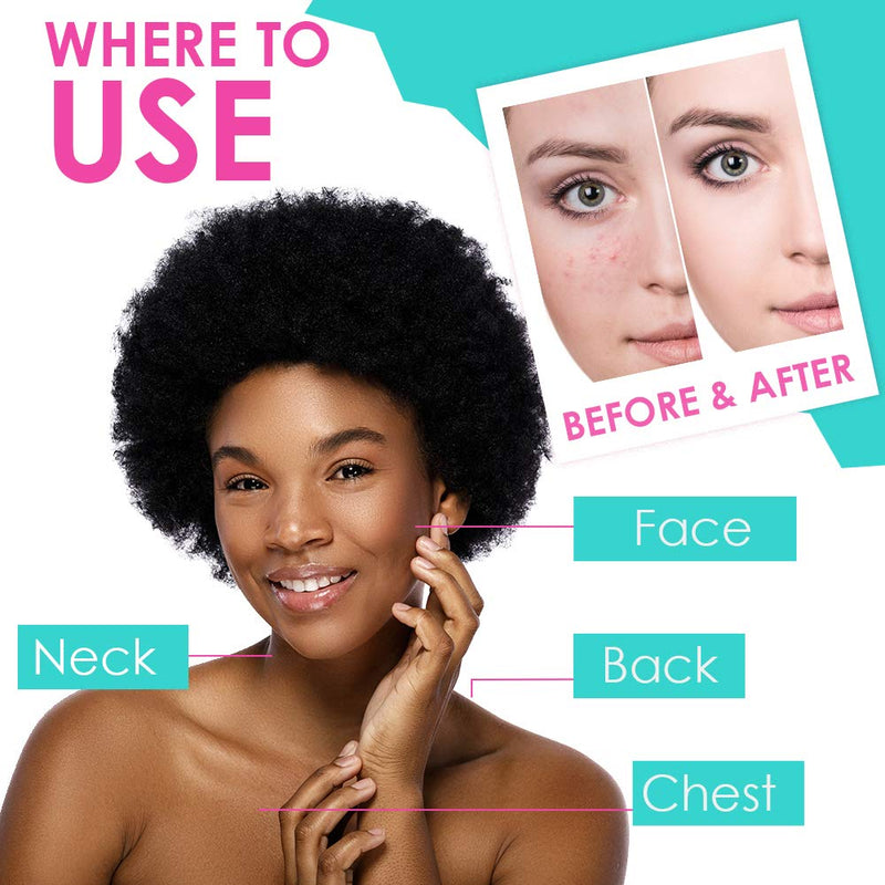 Bye Bye - Blemish Acne Drying Lotion 1 oz (2 Pack)
