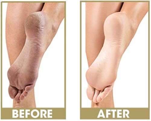 ProLinc - Cuticle Eliminator + Callus Eliminator 4oz Duo